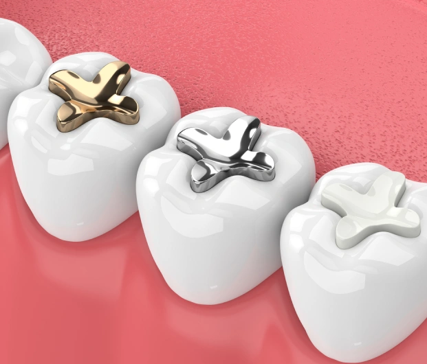 img-dental-fillings