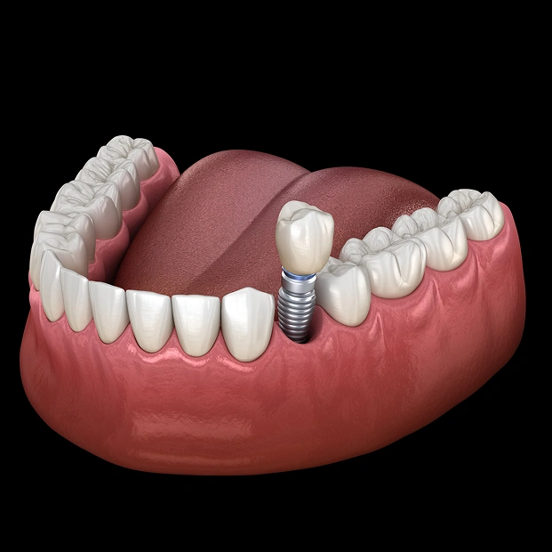 img-dental-implants