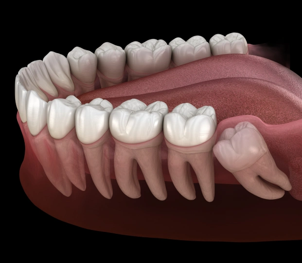 img-wisdom-teeth-removal