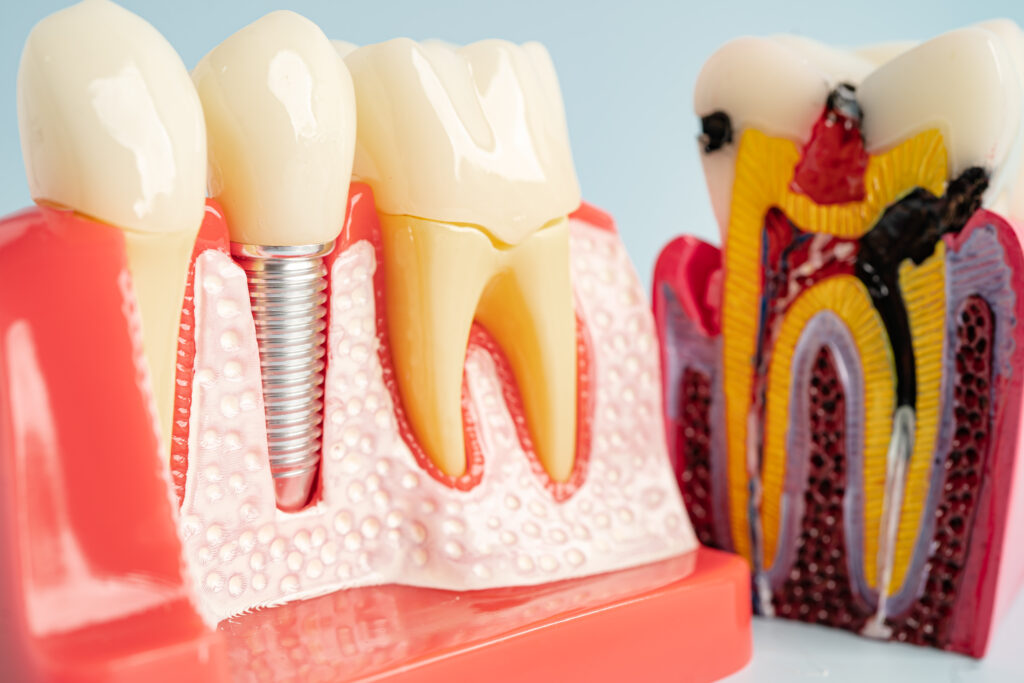 Dental implant model showing tooth replacement by nashua dentist